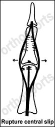 Rupture Central Slip